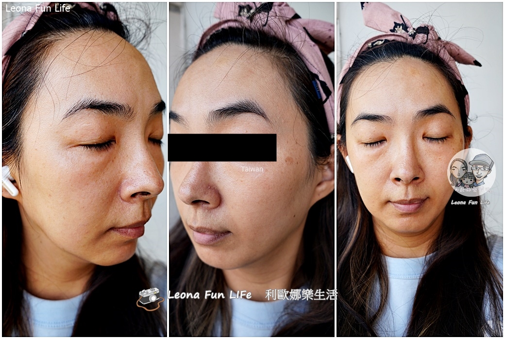 台中皮秒雷射推薦|小資美學真實心得：超中肯醫生不推銷，拯救長期外拍的曬斑與暗沉！