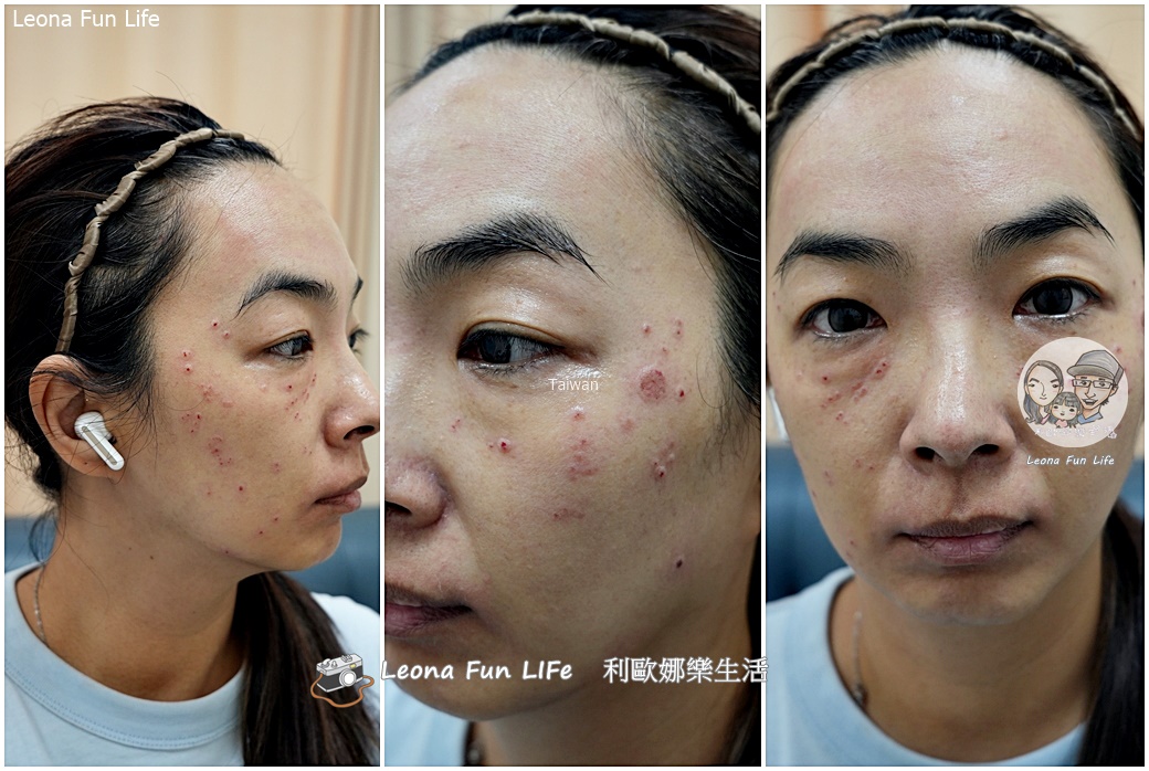 台中皮秒雷射推薦|小資美學真實心得：超中肯醫生不推銷，拯救長期外拍的曬斑與暗沉！