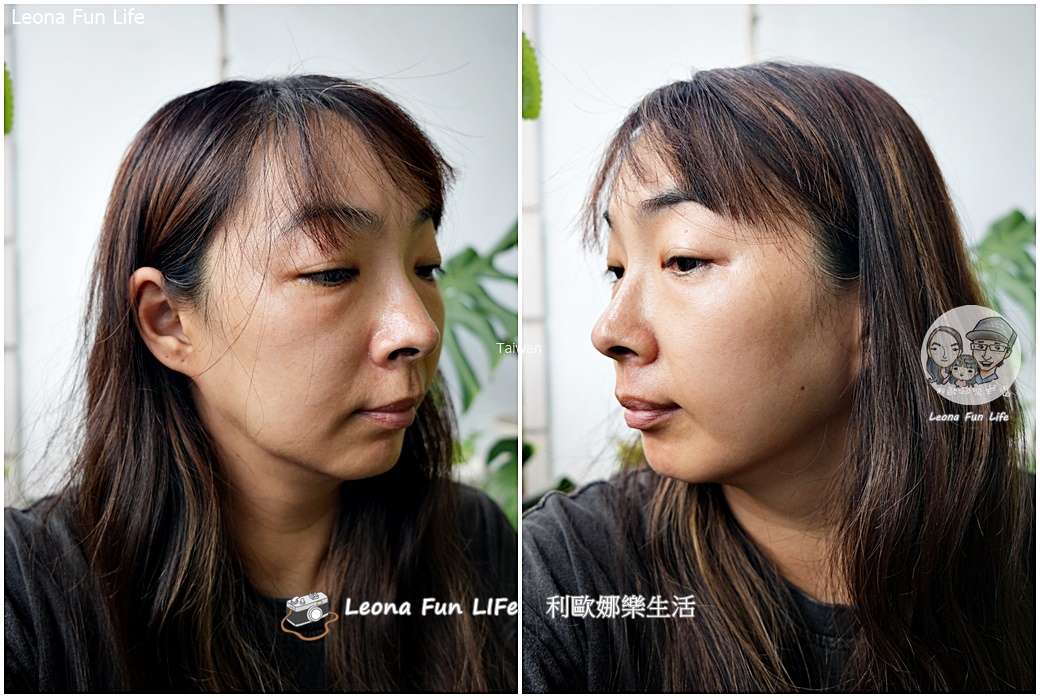 台中皮秒雷射推薦|小資美學真實心得：超中肯醫生不推銷，拯救長期外拍的曬斑與暗沉！